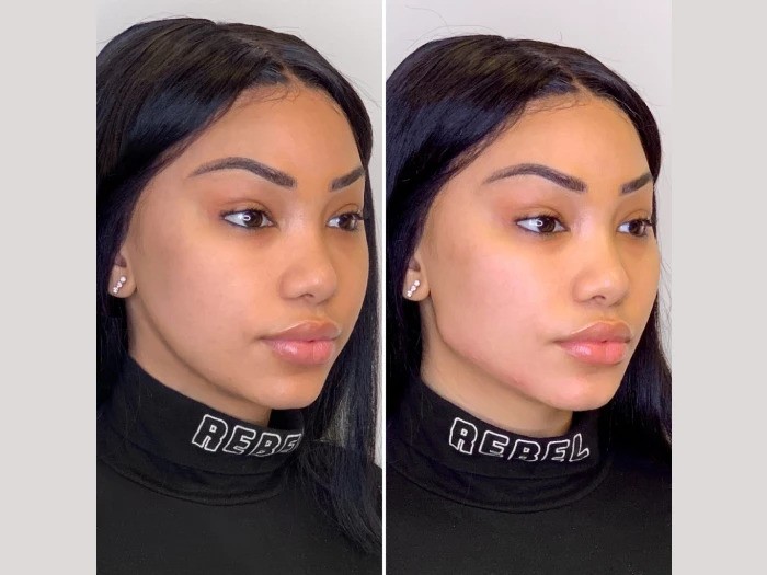 Thread Lift Advancements Used by Best Plastic Surgeon in Dubai