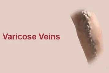 Varicose Veins Treatment Doctors